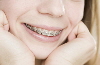 Dental Bridges Dental Bridges