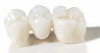Procera_Bridge_Zirconia-300x250 Procera_Bridge_Zirconia-300x250