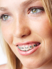 harlingen-braces